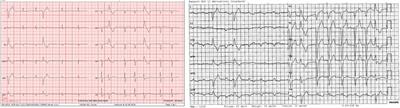 Case report: Stenosis turned leak … and turned stenosis—complications of paravalvular prosthetic leak closure with a plug device